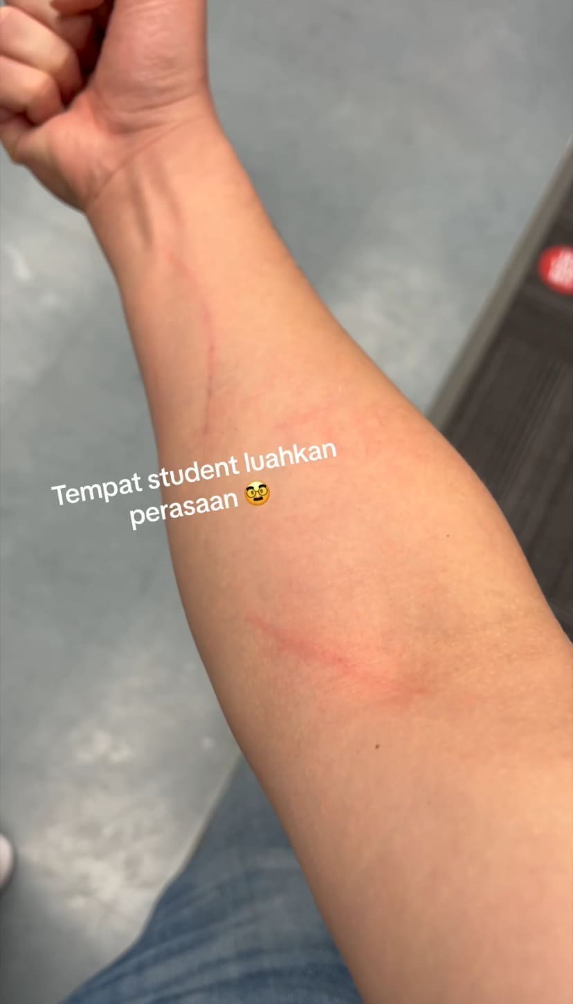 Scratches on arm