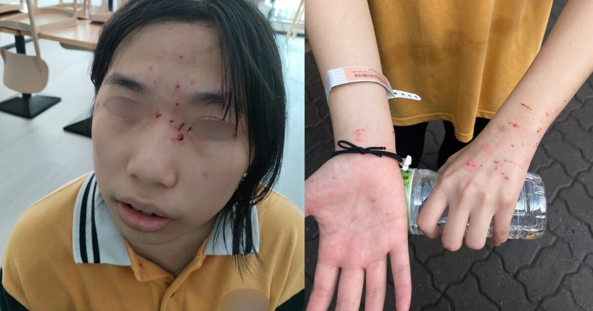 Injuries caused by glass beaker