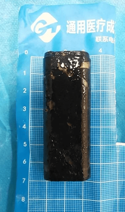 Lighter in China man's stomach