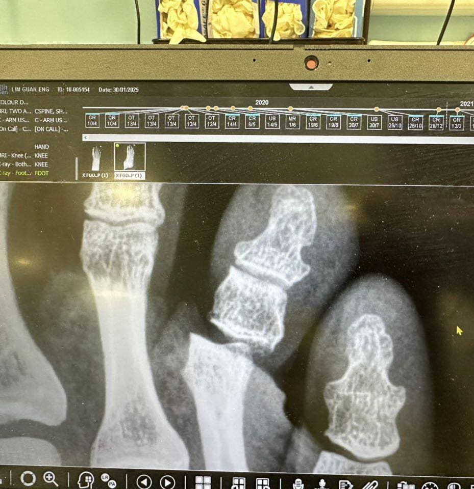 Lim Guan Eng's toe  x-ray scan report