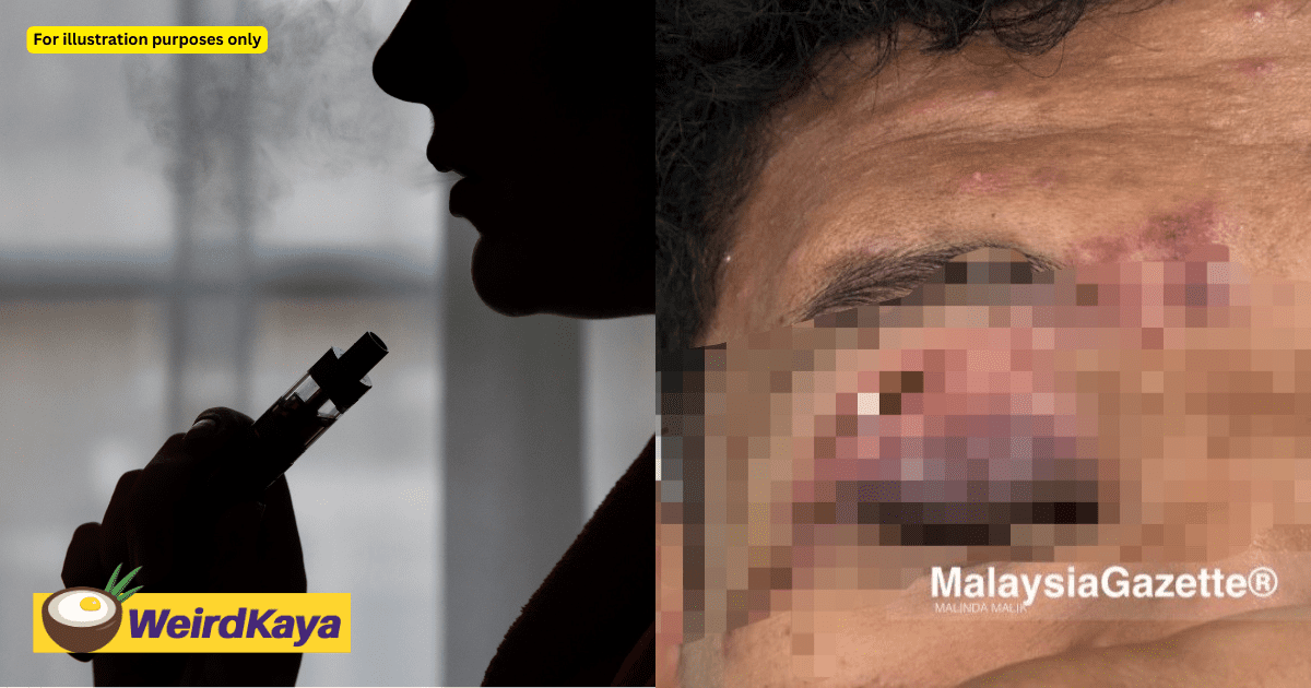 M'sian Student Allegedly Caned By Teacher On The Eye For Vaping, Suffers Bleeding & Swelling