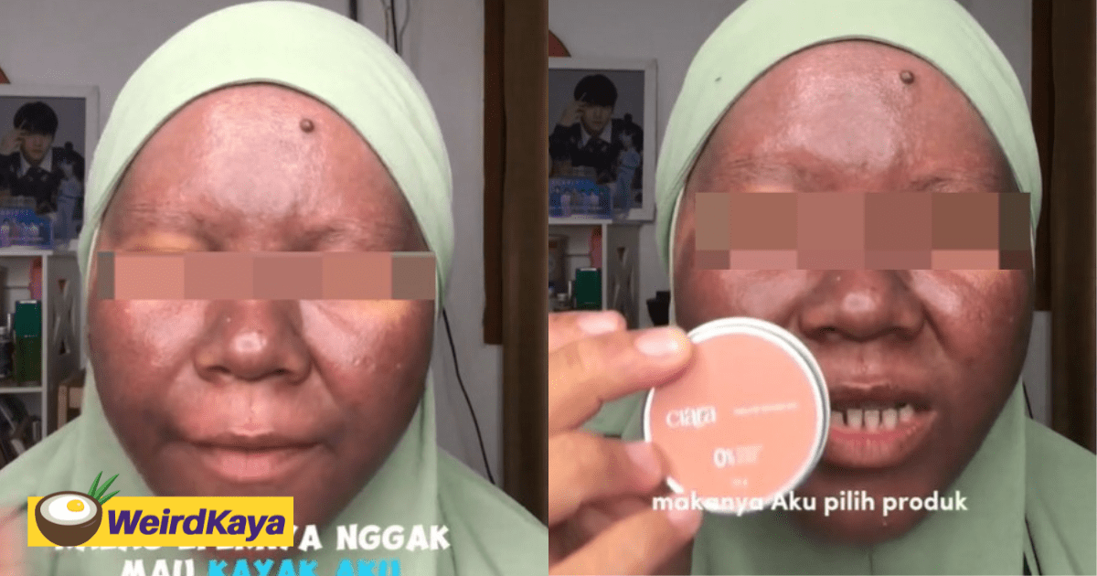 M'sian Woman's Skin Turns Dark After Using Mercury-Containing Whitening Skincare Products