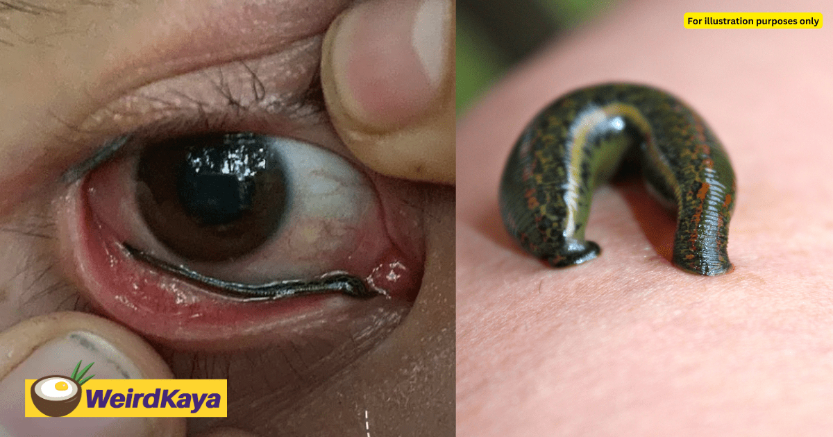 Leech Crawls Into Man's Eye, Making Him Spend More Than 30 Mins Getting It Out