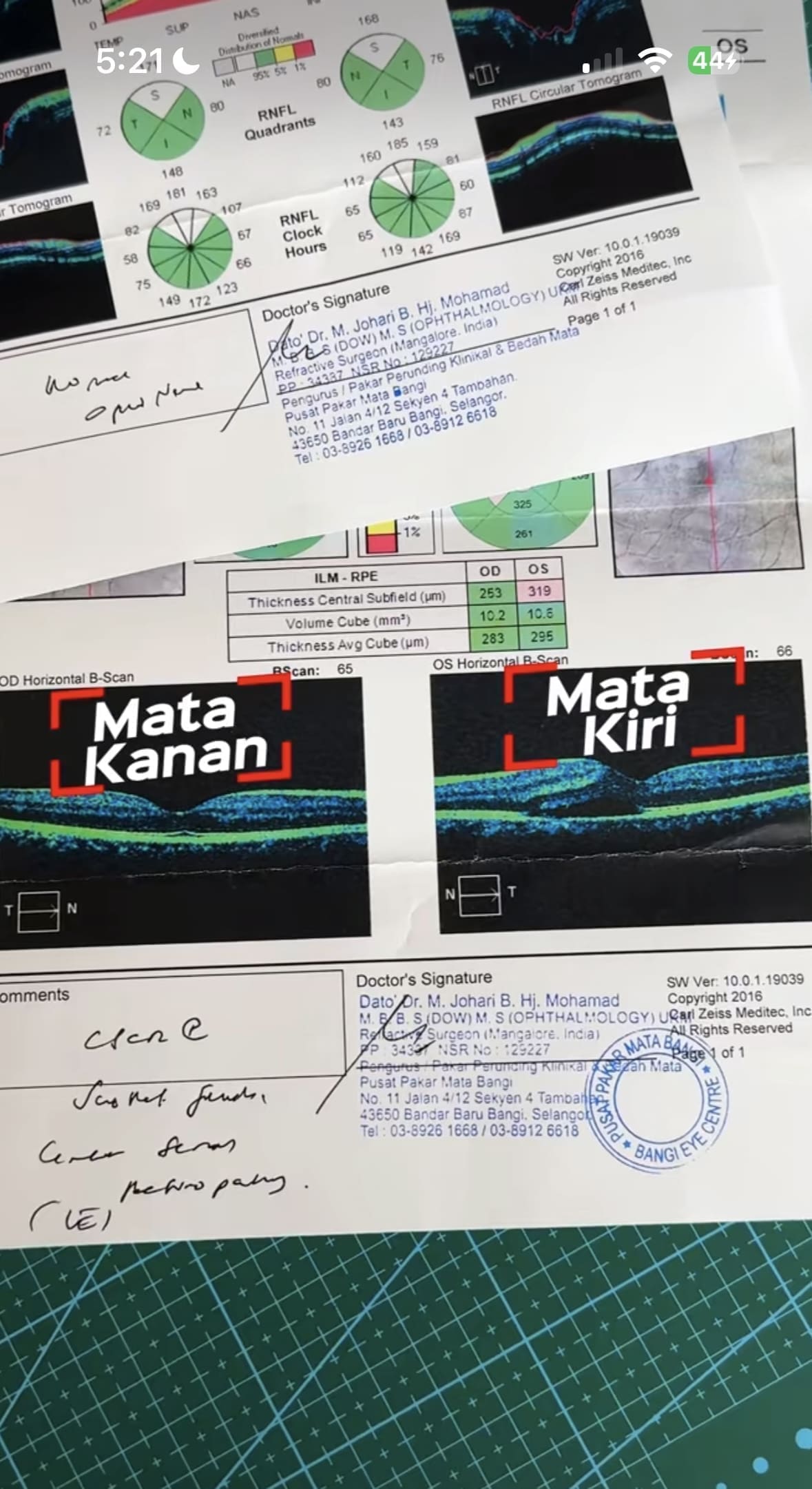 M'sian Man Almost Goes Blind Due To Unmanaged Stress