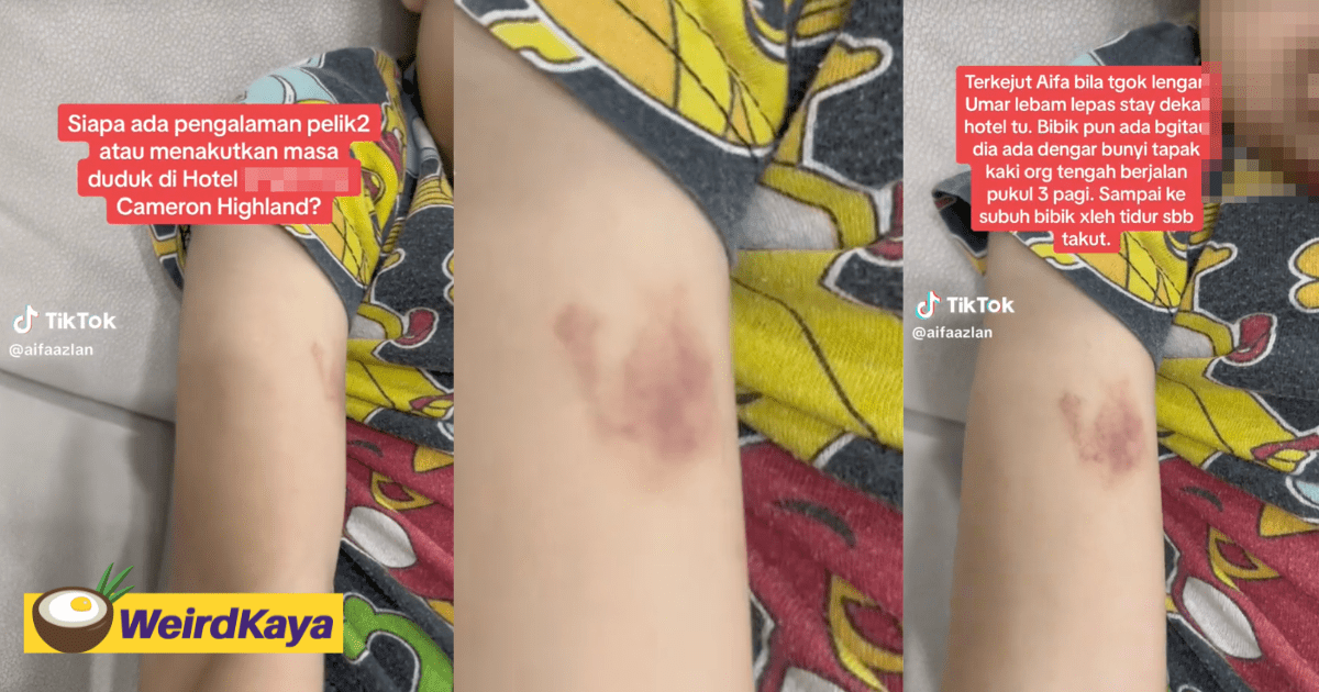 M'sian Mother Says Bruises Appeared On Son's Arm After Staying At Cameron Highlands, Claims It's A Paranormal Event
