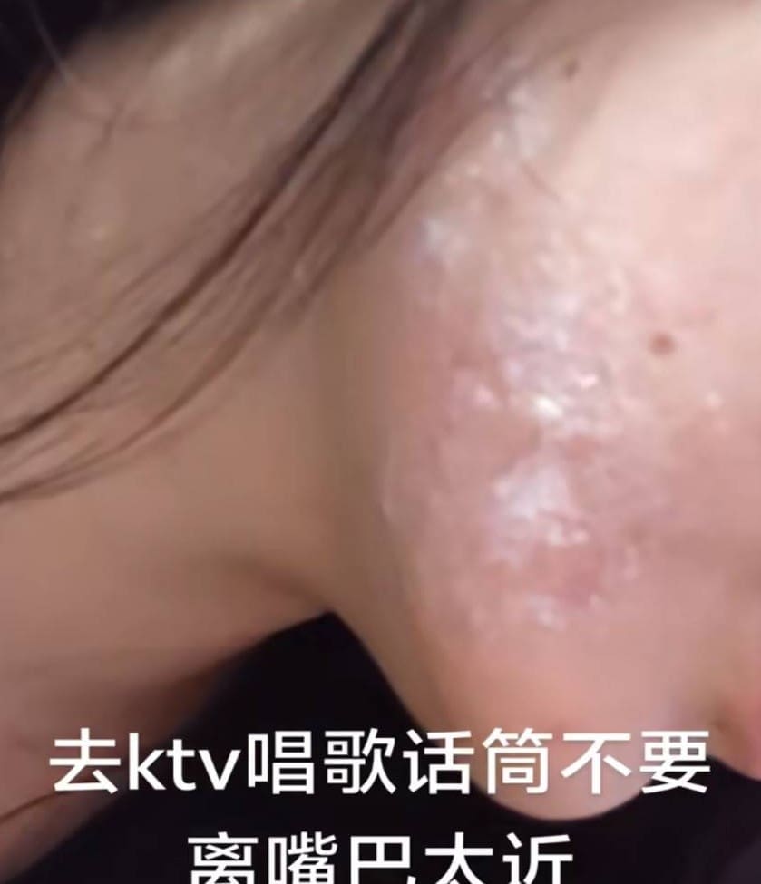 Oral herpes
