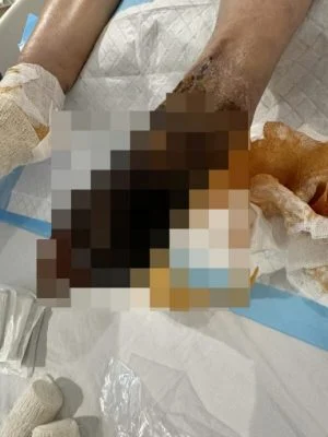 sepsis leg