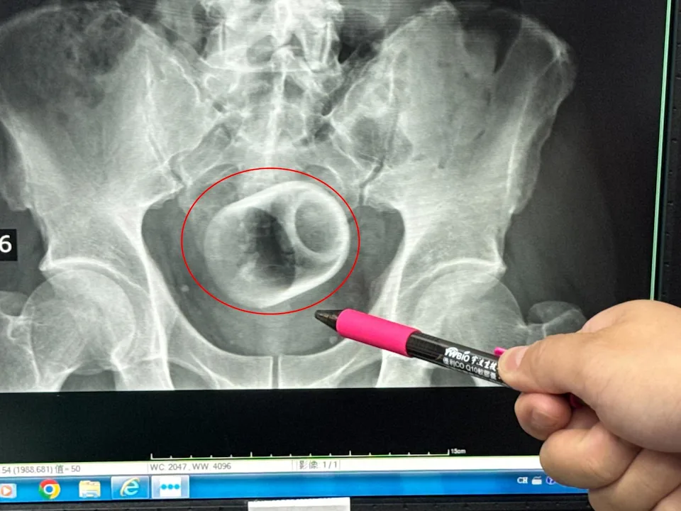 The ceramic cup in the patient's butt during X-ray