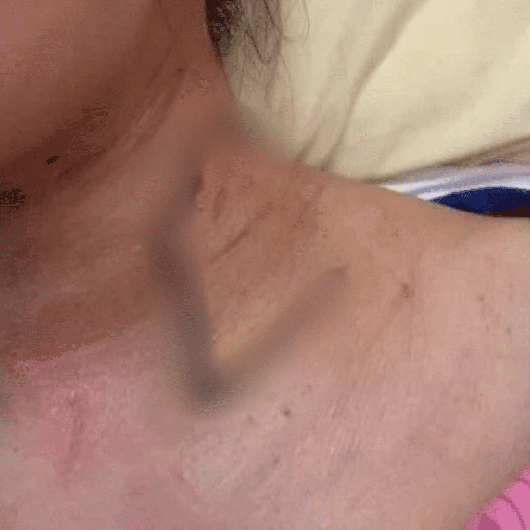 Victim suffer serious injury on her neck