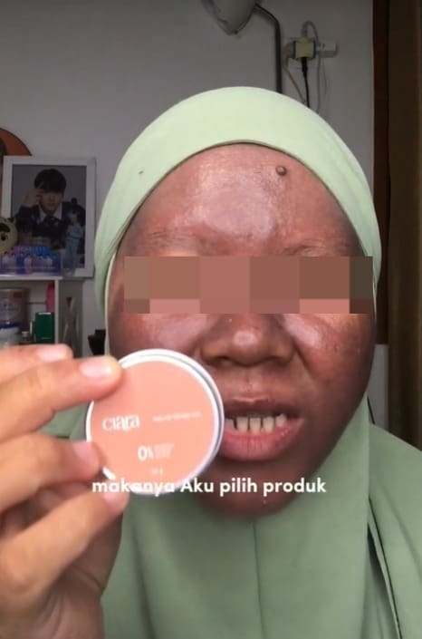 M'sian Woman's Skin Turns Dark After Using Mercury-Containing Whitening Skincare Products
