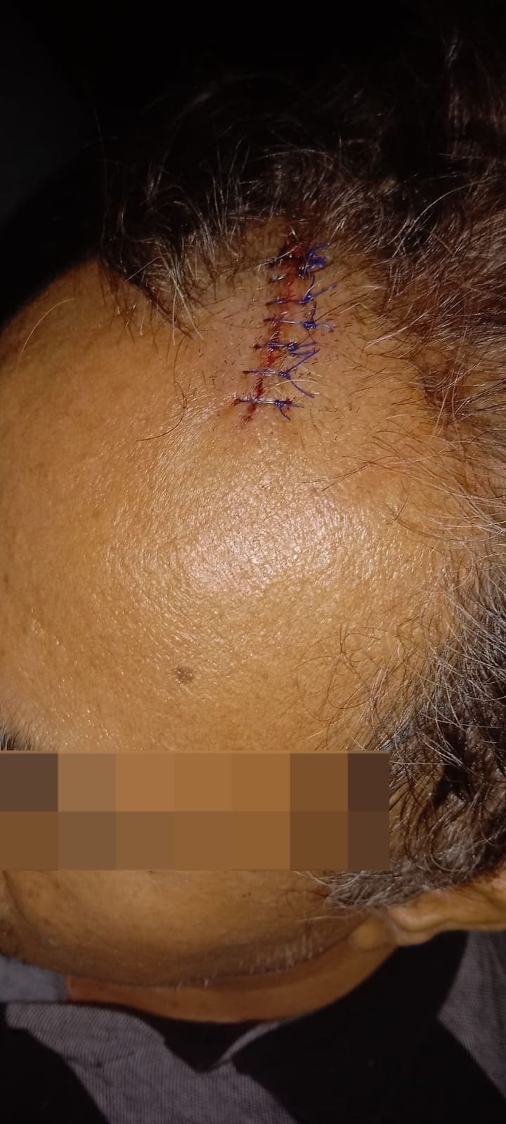 Msian man receives 7 stiches due the shutter pole injury