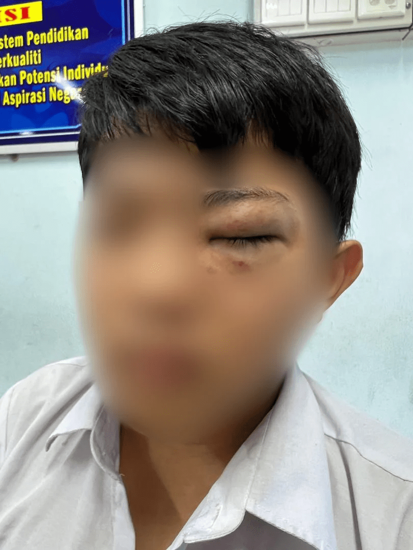 Zheng's son having a bruised eye